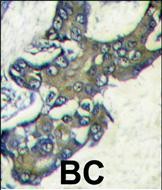 Formalin-fixed and paraffin-embedded human breast carcinoma tissue reacted with MAPK1 Antibody (C-term) (Cat
