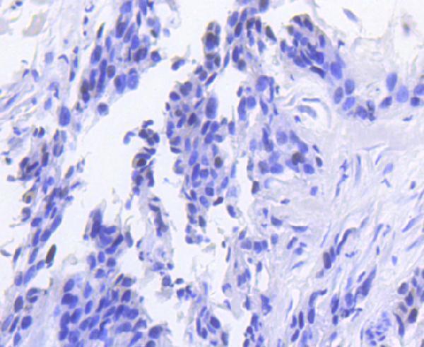 Immunohistochemical analysis of paraffin-embedded human breast carcinoma tissue using anti-Rb antibody