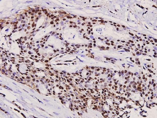 Immunohistochemistry (IHC) analyzes of p-Rb (S780) pAb in paraffin-embedded human breast carcinoma tissue at 1:100