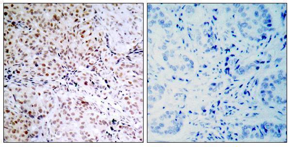 Immunohistochemistry analysis of paraffin-embedded human breast carcinoma, using Retinoblastoma (Phospho-Ser795) Antibody