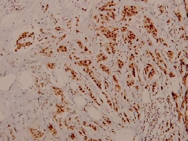 Immunohistochemistry (IHC) analyzes of p-Rb (S795) pAb in paraffin-embedded human breast carcinoma tissue at 1:100