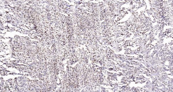 Immunohistochemical analysis of paraffin-embedded human Small intestinal stromal tumor