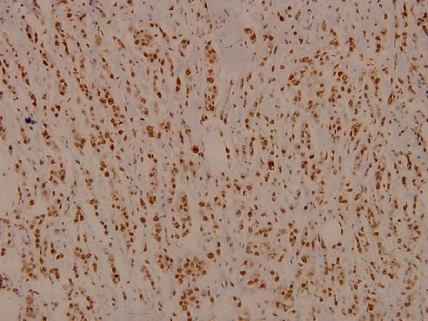 Immunohistochemistry (IHC) analyzes of Rb (T601) pAb in paraffin-embedded human breast carcinoma tissue at 1:100