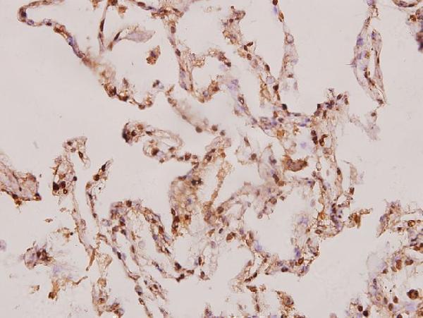 Immunohistochemistry (IHC) analyzes of Caspase-8 (S347) pAb in paraffin-embedded human lung carcinoma tissue at 1:100
