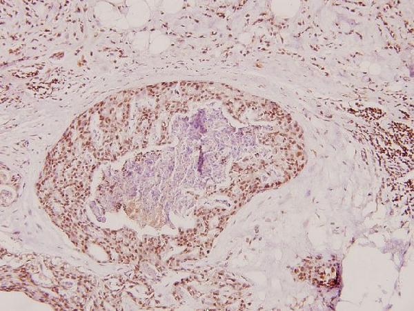 Immunohistochemistry (IHC) analyzes of Prothrombin (G724) pAb in paraffin-embedded human breast carcinoma tissue at 1:100
