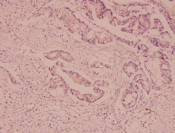 Immunohistochemistry (IHC) analyzes of P-glycoprotein 1 (I583) pAb in paraffin-embedded human colorectal cancer carcinoma tissue at 1:100
