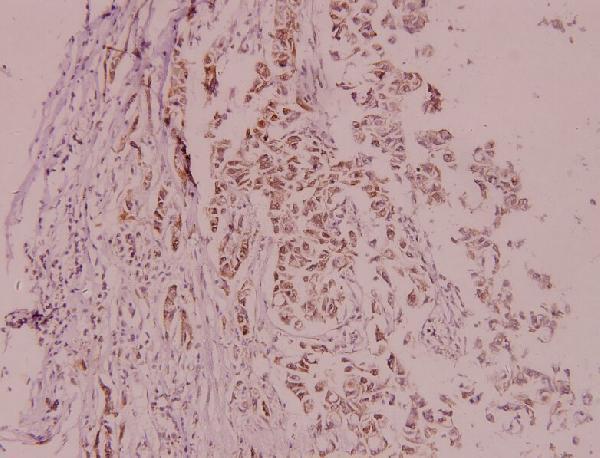 Immunohistochemistry (IHC) analyzes of MDM2 (F414) pAb in paraffin-embedded human breast carcinoma tissue at 1:100