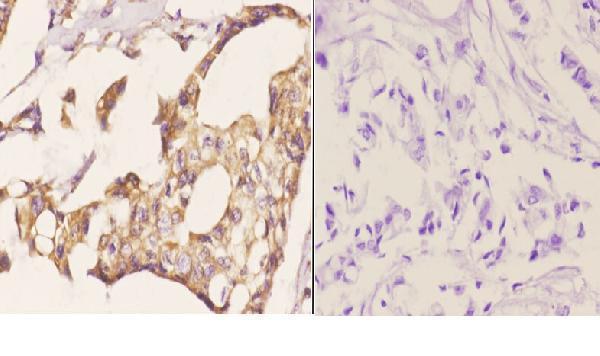 Immunohistochemistry (IHC) analyzes of MDM2 (S160) pAb in paraffin-embedded human breast carcinoma tissue at 1:50