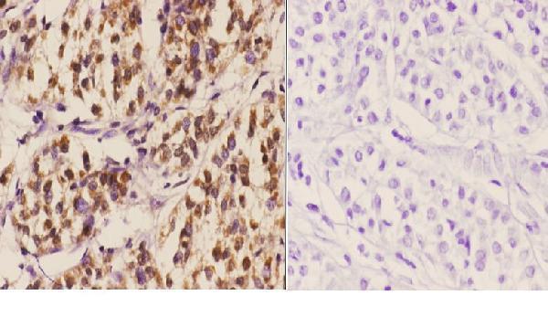 Immunohistochemistry (IHC) analyzes of MDM2 (S160) pAb in paraffin-embedded human liver carcinoma tissue at 1:50