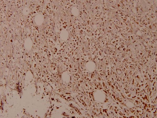 Immunohistochemistry (IHC) analyzes of p-MDM2 (S166) pAb in paraffin-embedded human breast carcinoma tissue at 1:100