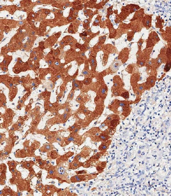 Immunohistochemical analysis of paraffin-embedded Human hepatocarcinoma tissue using A00062-3 performed on the Leica® BOND RXm