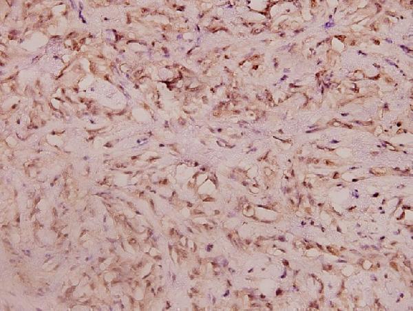 Immunohistochemistry (IHC) analyzes of Haptoglobin (V328) pAb in paraffin-embedded human breast carcinoma tissue at 1:100