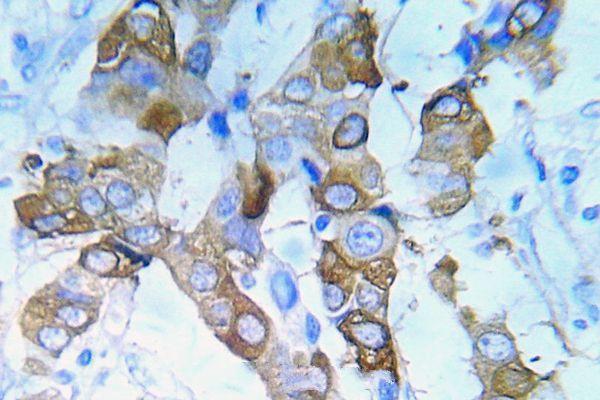 Immunohistochemistry (IHC) analyzes of p-IGF1R (Y980) pAb in paraffin-embedded human lung adenocarcinoma tissue