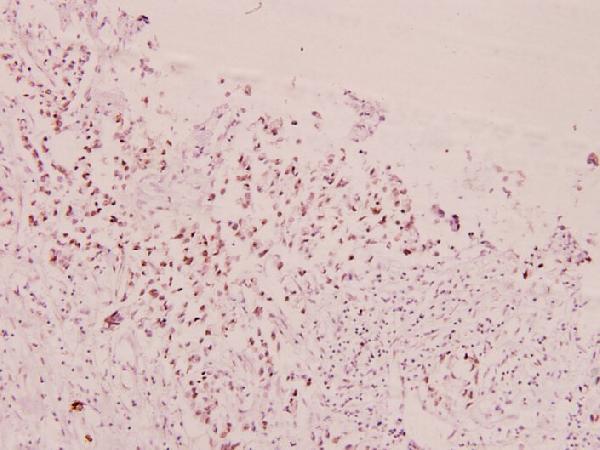 Immunohistochemistry (IHC) analyzes of p-FoxO1/3/4 (T24/32) pAb in paraffin-embedded human breast carcinoma tissue at 1:100