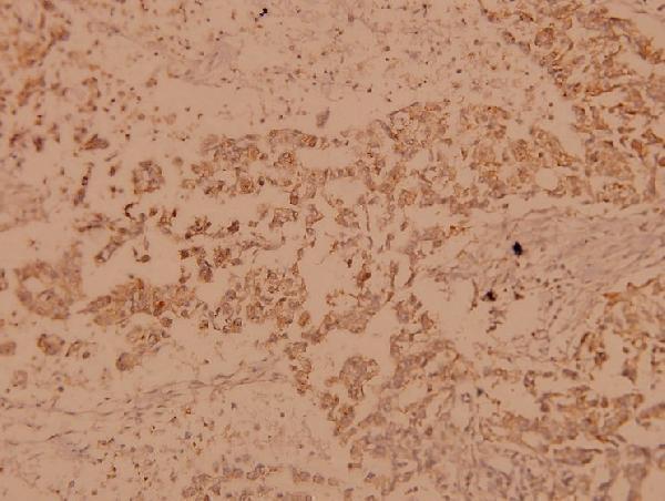 Immunohistochemistry (IHC) analyzes of Raf-B (A597) pAb in paraffin-embedded human breast carcinoma tissue at 1:100