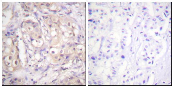 Immunohistochemistry analysis of paraffin-embedded human breast carcinoma, using B-RAF (Phospho-Thr599) Antibody