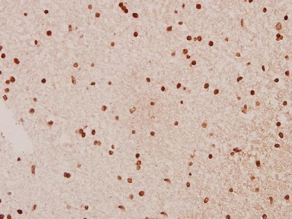 Immunohistochemistry (IHC) analyzes of Raf-B (Y198) pAb in paraffin-embedded human brain carcinoma tissue at 1:50