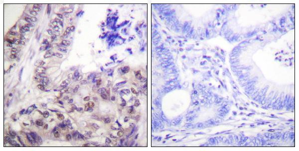 Immunohistochemistry analysis of paraffin-embedded human colon carcinoma, using Caspase 9 (Phospho-Ser144) Antibody