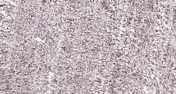 Immunohistochemical analysis of paraffin-embedded human Colon cancer