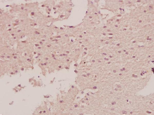 Immunohistochemistry (IHC) analyzes of c-Fms (E557) pAb in paraffin-embedded human brain carcinoma tissue at 1:50