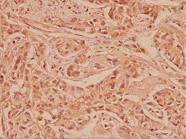 Immunohistochemistry (IHC) analyzes of Cox-2 (T594) pAb in paraffin-embedded human breast carcinoma tissue at 1:100