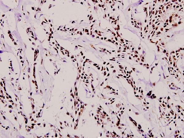 Immunohistochemistry (IHC) analyzes of RUNX1 (H297) pAb in paraffin-embedded human breast carcinoma tissue at 1:100
