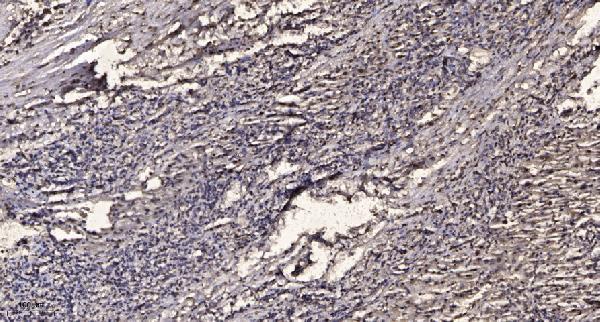Immunohistochemical analysis of paraffin-embedded human liver cancer