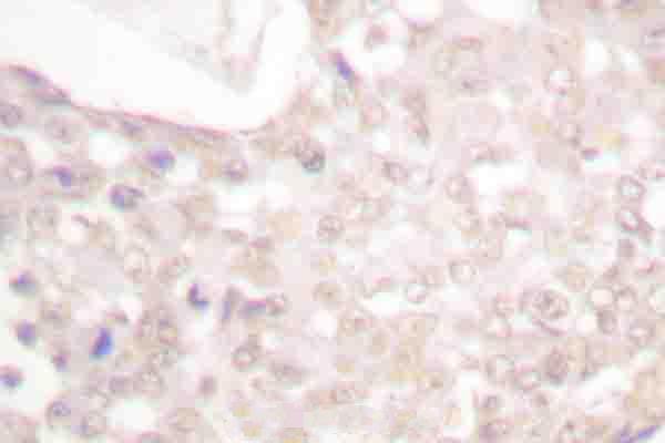 Immunohistochemistry (IHC) analyzes of p-Smad2 (S467) pAb in paraffin-embedded human breast cancer tissue