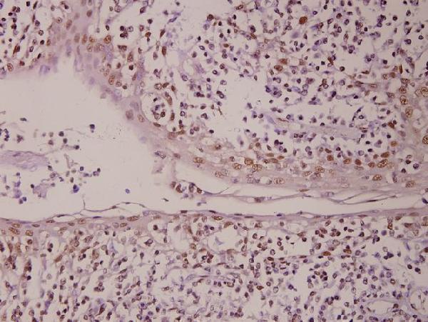 Immunohistochemistry (IHC) analyzes of PML (P39) pAb in paraffin-embedded human tonsil carcinoma tissue at 1:50