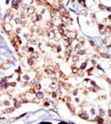 Formalin-fixed and paraffin-embedded human cancer tissue reacted with the primary antibody, which was peroxidase-conjugated to the secondary antibody, followed by DAB staining
