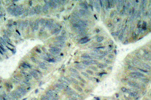 Immunohistochemistry (IHC) analyzes of p-Src (Y418) pAb in paraffin-embedded human colon carcinoma tissue