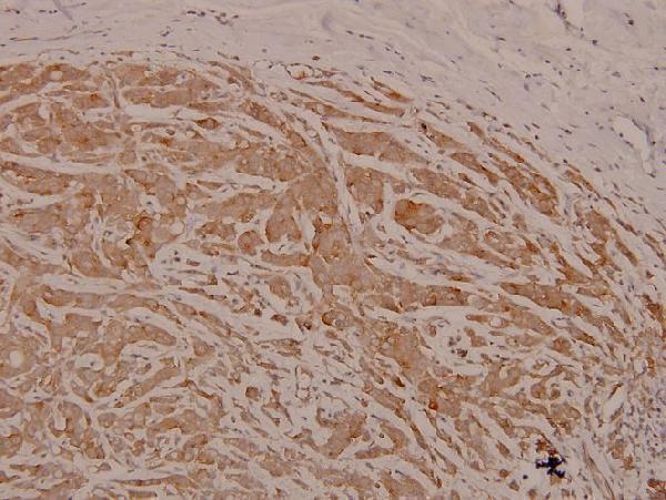 Immunohistochemistry (IHC) analyzes of p-c-Src (Y529) pAb in paraffin-embedded human breast carcinoma tissue at 1:100