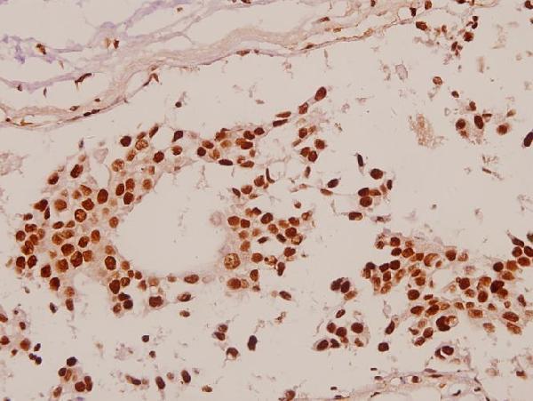 Immunohistochemistry (IHC) analyzes of Sp1 (G447) pAb in paraffin-embedded human breast carcinoma tissue at 1:50