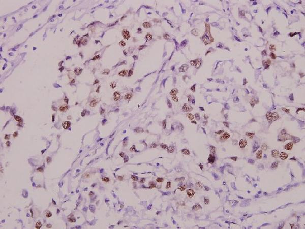 Immunohistochemistry (IHC) analyzes of p-Sp1 (T453) pAb in paraffin-embedded human breast carcinoma tissue at 1:50