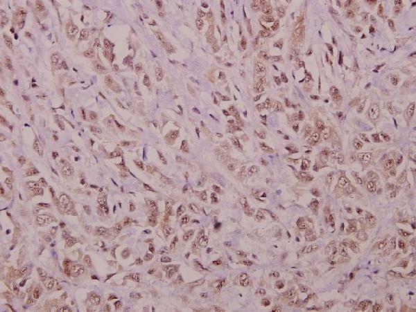 Immunohistochemistry (IHC) analyzes of YAP (H122) pAb in paraffin-embedded human colorectal carcinoma tissue at 1:50