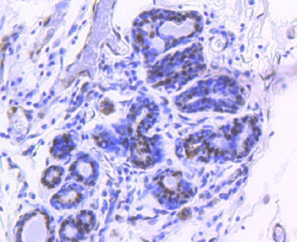 Immunohistochemical analysis of paraffin-embedded human breast carcinoma tissue using anti- phospho-YAP1 (S127) antibody