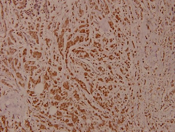 Immunohistochemistry (IHC) analyzes of p-IKKβ (Y199) pAb in paraffin-embedded human breast carcinoma tissue at 1:100