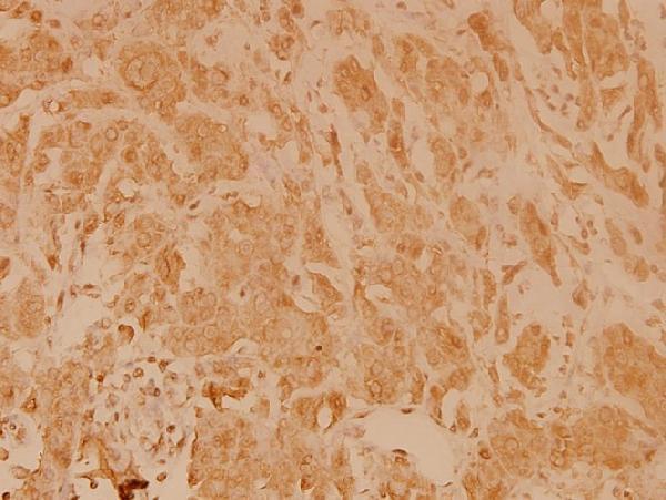 Immunohistochemistry (IHC) analyzes of eIF4E (T203) pAb in paraffin-embedded human breast carcinoma tissue at 1:100