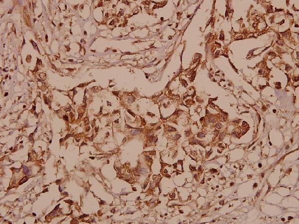 Immunohistochemistry (IHC) analyzes of SHP-2 (S350) pAb in paraffin-embedded human breast carcinoma tissue at 1:50