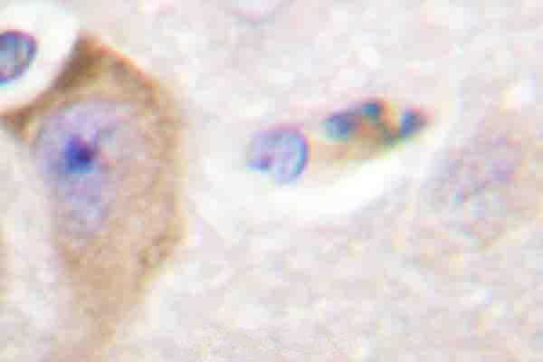 Immunohistochemistry (IHC) analyzes of p-SHP-2 (Y542) pAb in paraffin-embedded human breast cancer tissue