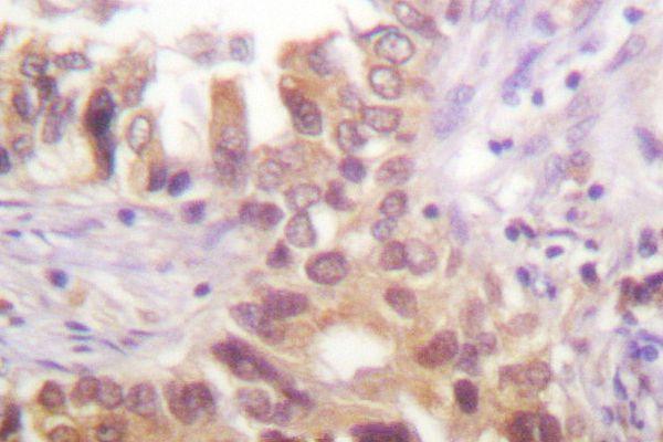 Immunohistochemistry (IHC) analyzes of IRF-3 (A379) pAb in paraffin-embedded human lung carcinoma tissue
