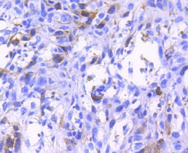 Immunohistochemical analysis of paraffin-embedded human breast carcinoma tissue using anti-Phospho-Cdk2(Y15) antibody