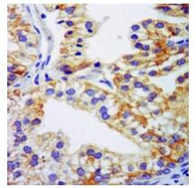 Immunohistochemical analysis of Complement C3 staining in human liver cancer formalin fixed paraffin embedded tissue section