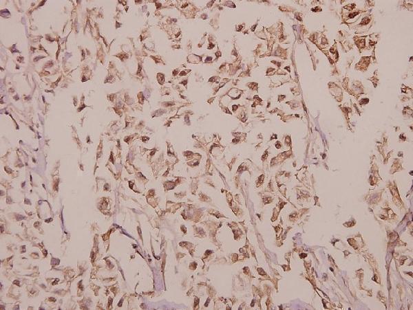 Immunohistochemistry (IHC) analyzes of p38 (T175) pAb in paraffin-embedded human colorectal carcinoma tissue at 1:50