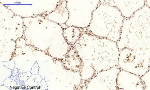 Immunohistochemical analysis of paraffin-embedded Human-lung-cancer tissue