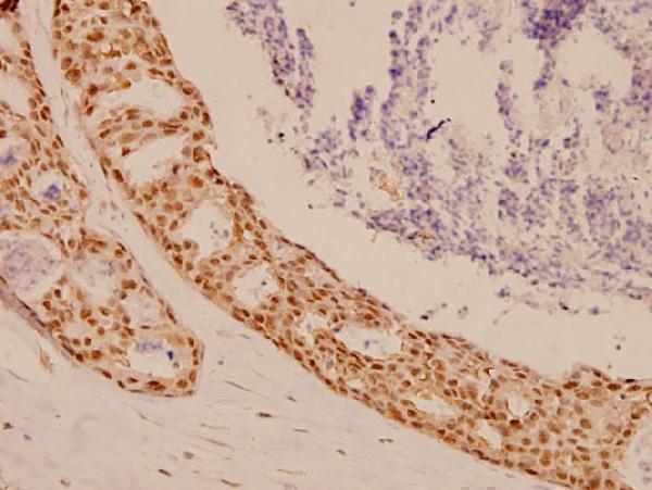 Immunohistochemistry (IHC) analyzes of Sox9 (Q175) pAb in paraffin-embedded human breast carcinoma tissue at 1:100