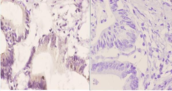 Immunohistochemistry (IHC) analyzes of p-SOX9 (S181) pAb in paraffin-embedded human colon carcinoma tissue at 1:50