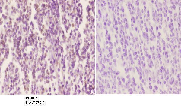 Immunohistochemistry (IHC) analyzes of p-SOX9 (S181) pAb in paraffin-embedded human tonsil carcinoma tissue at 1:50