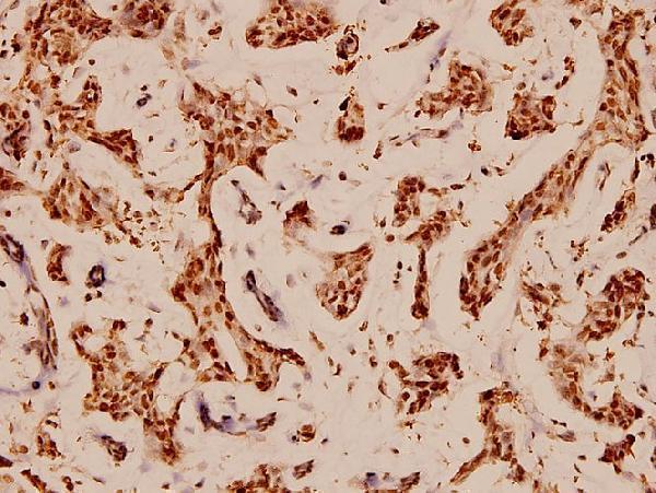 Immunohistochemistry (IHC) analyzes of Bcl-X (S43) pAb in paraffin-embedded human breast carcinoma tissue at 1:100