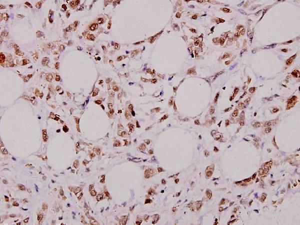 Immunohistochemistry (IHC) analyzes of Bcl-X (S56) pAb in paraffin-embedded human breast carcinoma tissue at 1:100